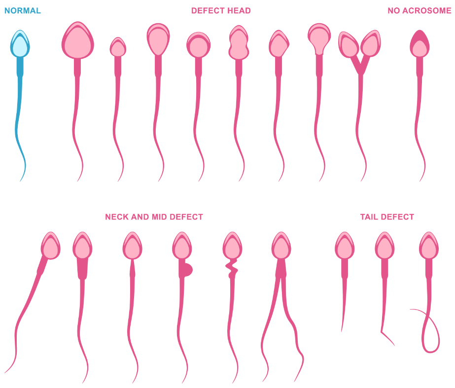 deformácie spermií